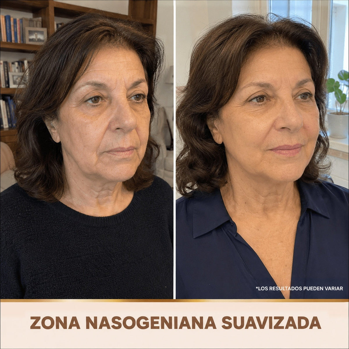 Zona nasogeniana suavizada