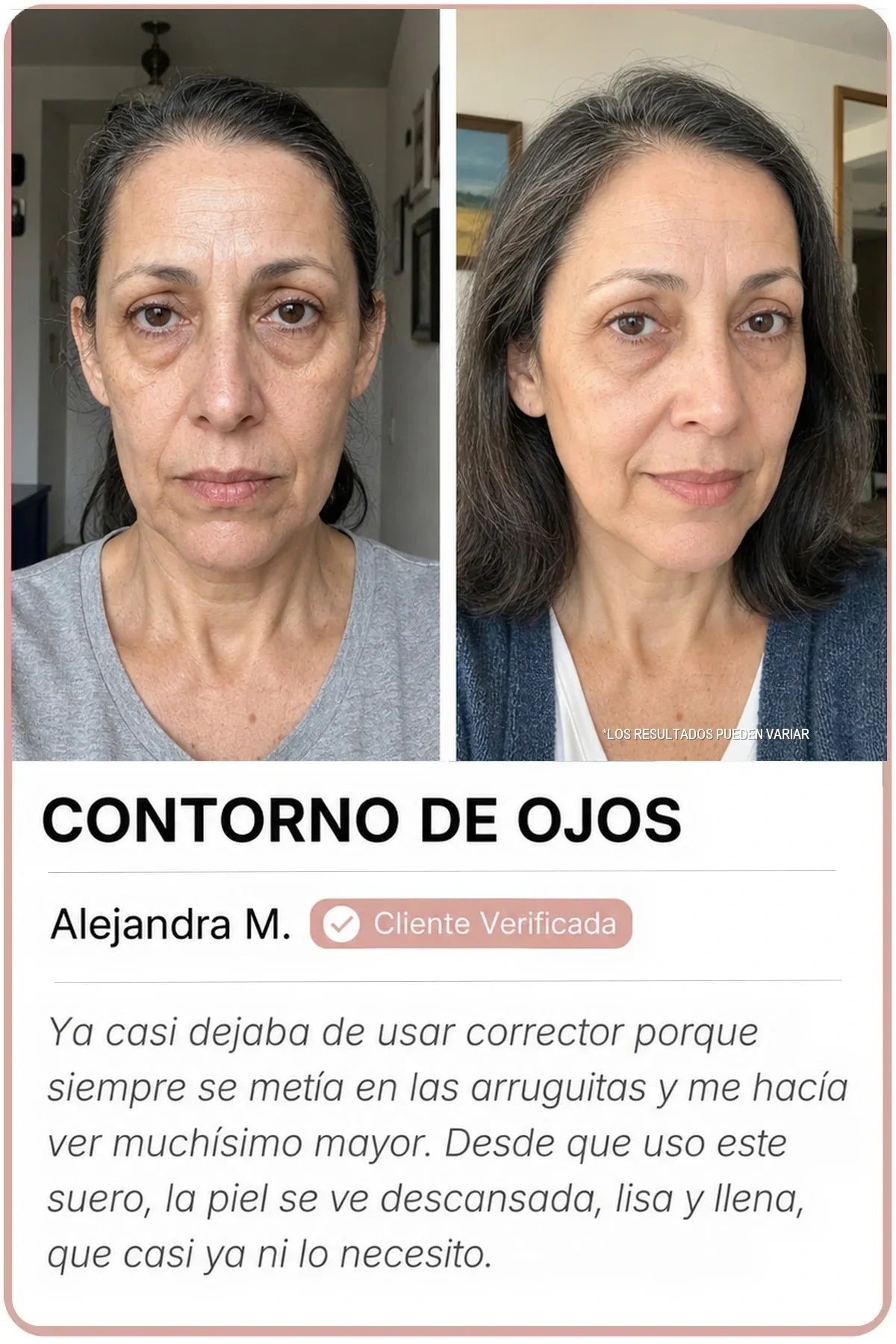 Antes y después Sedanza — Contorno de ojos, Alejandra M.