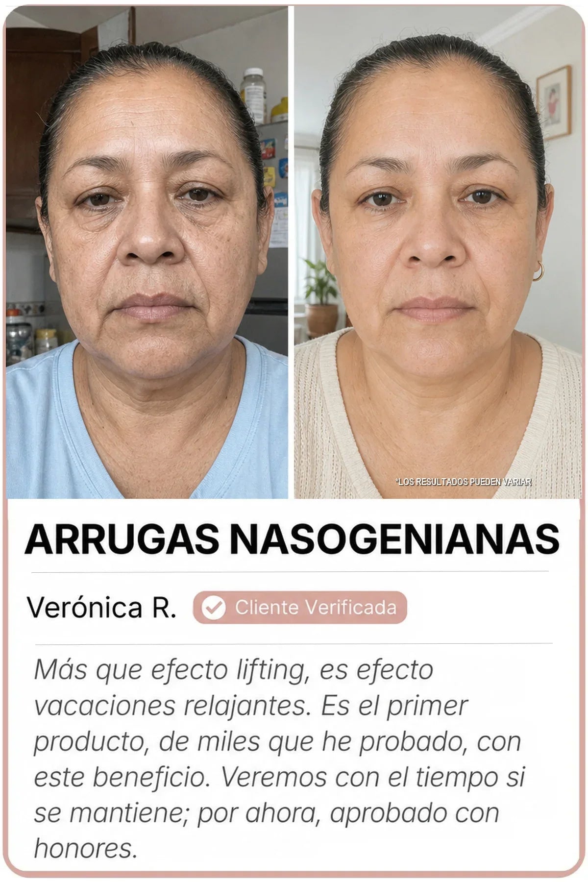 Antes y después Sedanza — Arrugas nasogenianas, Verónica R.