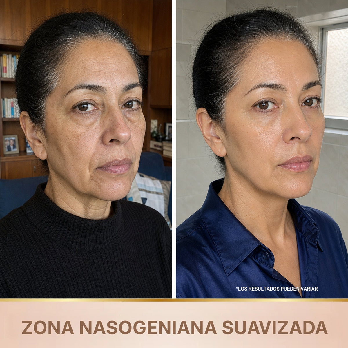 Zona nasogeniana suavizada - antes y despues