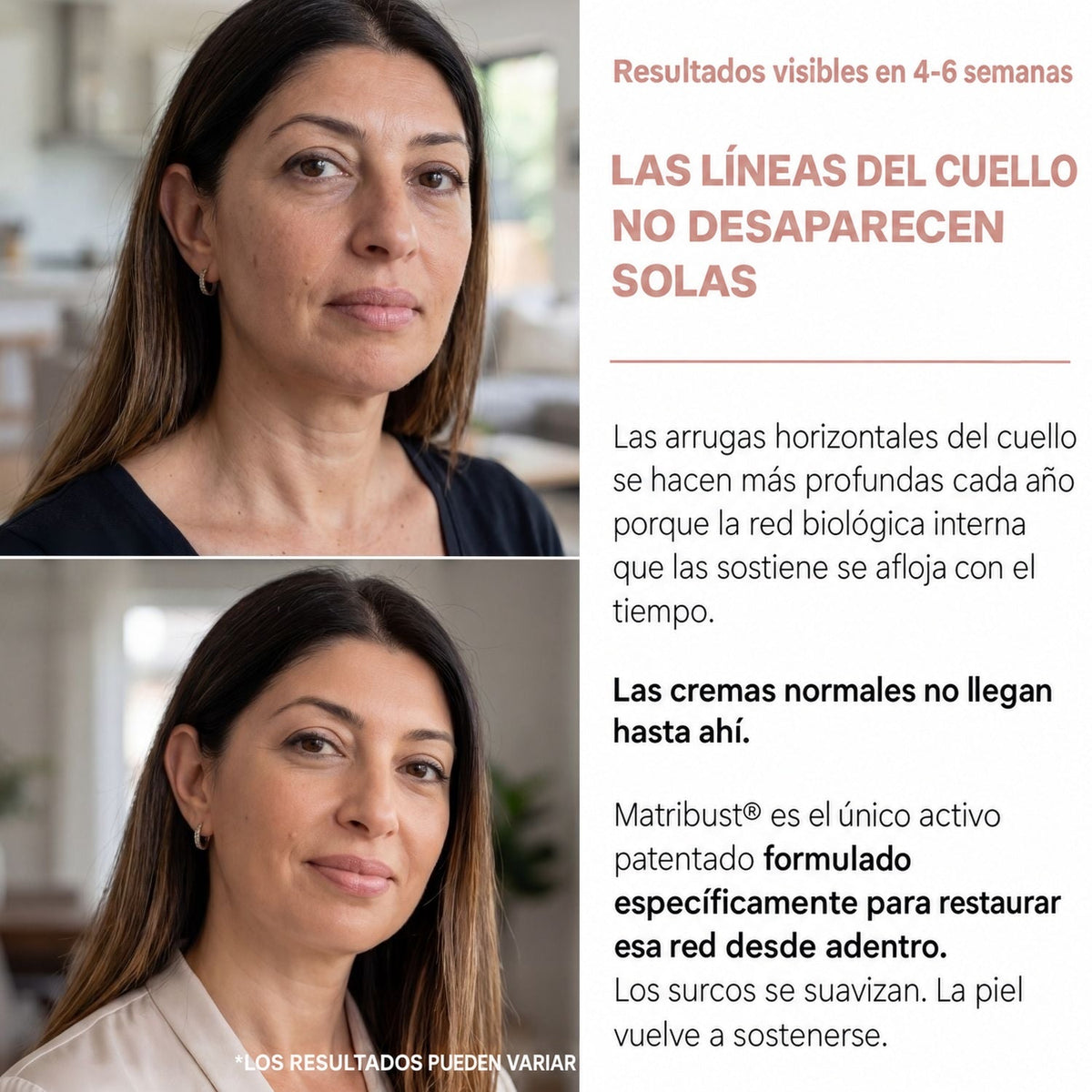 Las líneas del cuello no desaparecen solas